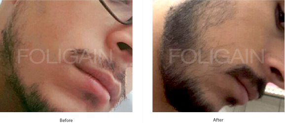 MINOXIDIL FOLIGAIN TRATAMIENTO PARA EL RECRECIMIENTO DEL CABELLO Para Hombres (6 fl oz) 180ml Suministro para 3 Meses + FOLIGAIN PARA LA PÉRDIDA DEL CABELLO 120 Cápsulas PACK AHORRO de FOLIGAIN - BIOVEA ESPAÑA