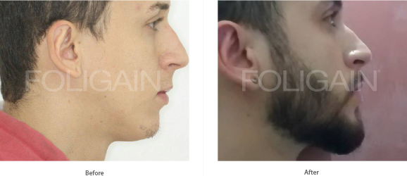 MINOXIDIL FOLIGAIN TRATAMIENTO PARA EL RECRECIMIENTO DEL CABELLO Para Hombres (6 fl oz) 180ml Suministro para 3 Meses + FOLIGAIN PARA LA PÉRDIDA DEL CABELLO 120 Cápsulas PACK AHORRO de FOLIGAIN - BIOVEA ESPAÑA