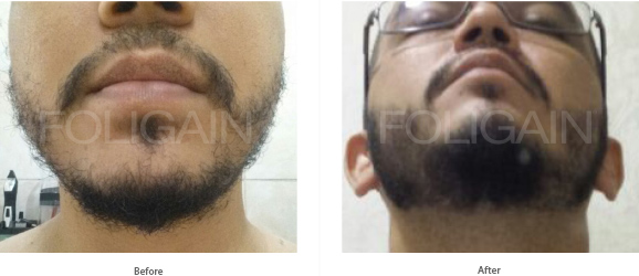 MINOXIDIL FOLIGAIN TRATAMIENTO PARA EL RECRECIMIENTO DEL CABELLO Para Hombres (6 fl oz) 180ml Suministro para 3 Meses + FOLIGAIN PARA LA PÉRDIDA DEL CABELLO 120 Cápsulas PACK AHORRO de FOLIGAIN - BIOVEA ESPAÑA